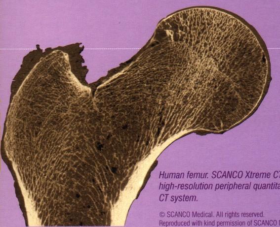 Xtreme CT - kortikální kost v proximálním