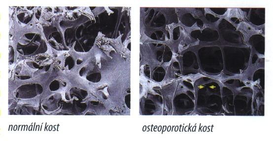 Osteoporóza je systémové onemocnění skeletu snížení pevnosti kosti nízká kostní denzita