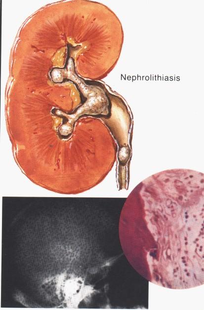 Primární HPT Nefrolithiasis, polyúrie, polydypsie