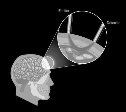 NIRS u TBI Chybí standardizace rsco2 60% rizikové pro těžkou hypoxii mozku (senzitivita 73%,