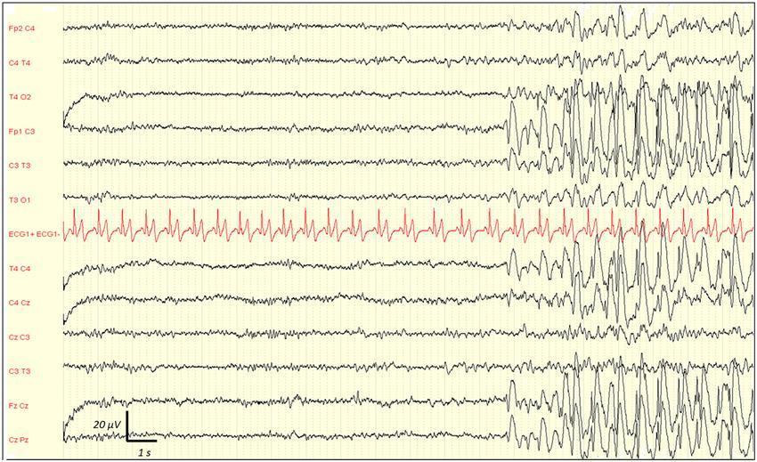 jednorázové EEG Kvantitativní EEG hodnocení pro intenzivisty