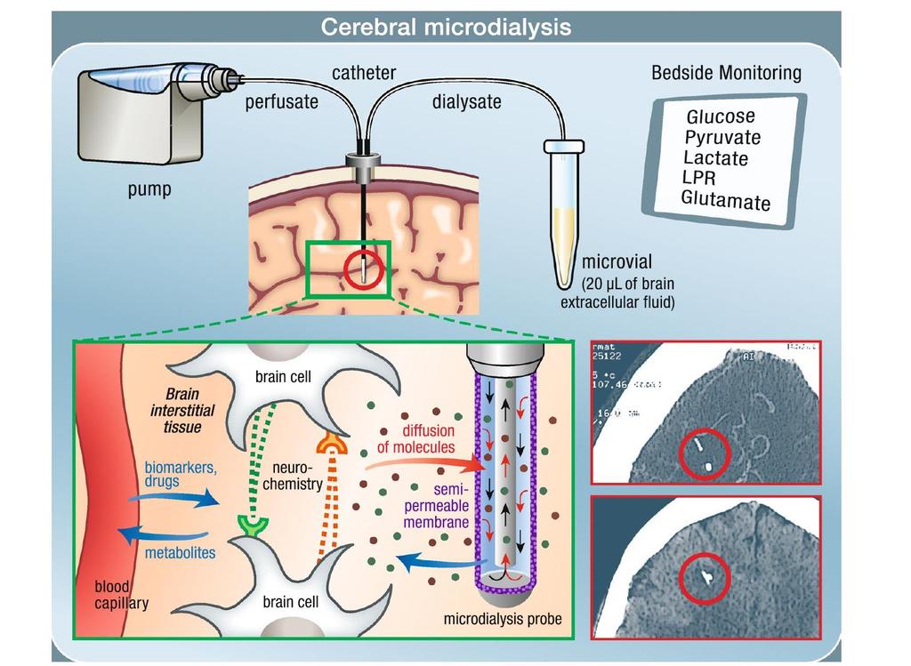 Mikrodialýza Katétr do nepostižené mozkové tkáně Analýza po 30-60 minutovách glukóza, laktát, pyruvát (laktát/pyruvát ratio), glutamát, glycerol, Na+, K+ detekce