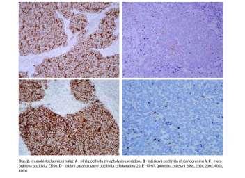 Dermatologické vyšetření ani staging pomoci PET CT ložisko primárního nádoru v jiné lokalizaci u pacienta