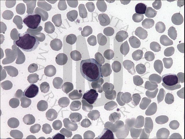 Chronická lymfatická leukemie CLL Lymfoproliferace se