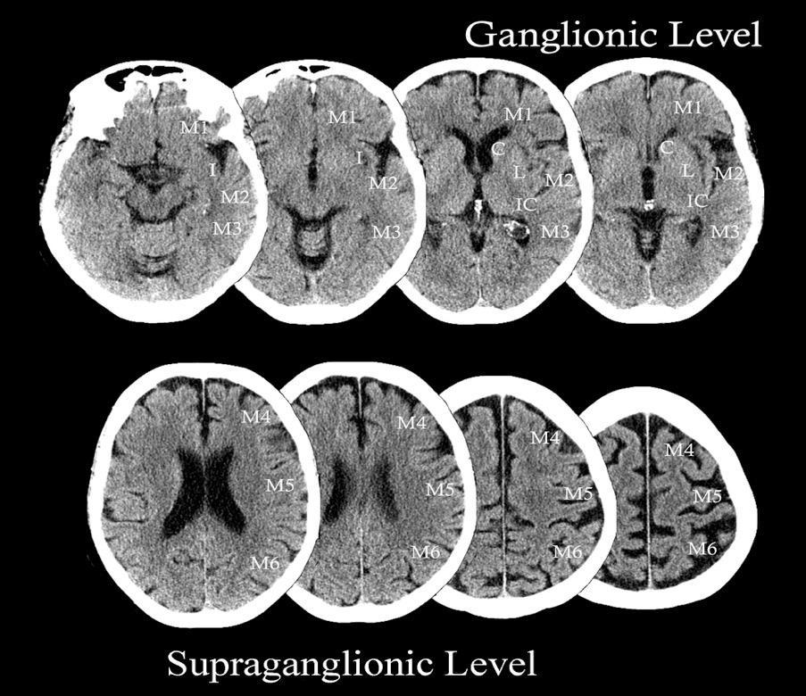 ASPECTS (Alberta Stroke Program Early CT score) 0 až 10 bodů 10 bodů = bez časných