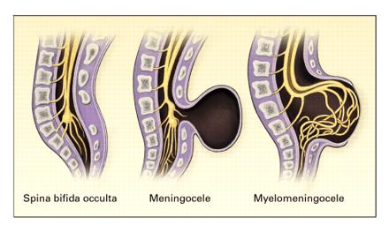 Defekty neur{lní trubice (Neural tube defects - NTD) porucha uzavírání neurální trubice v I.