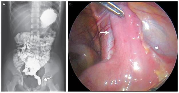 Diverticulum ilei Meckeli http://www.