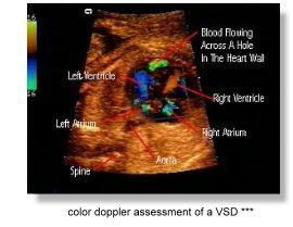 Hitem poslední doby je 3-D ultrazvuk, umožňující trojrozměrné prohlížení plodu.