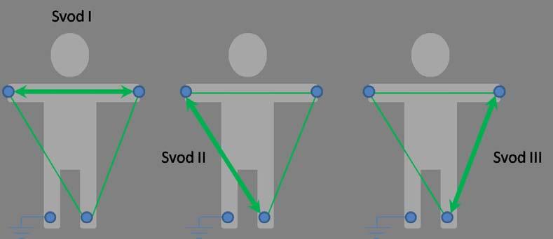 Klidové EKG Nejčastější snímáni EKG signálu, kdy pacient leží na lůžku. Zájmová frekvenční oblast u tohoto snímání je do 125 Hz (děti až do 150 Hz).