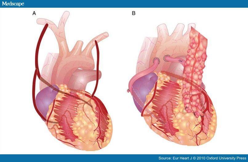 Eur Heart J 2008 Jun;29(11):1346-9 Falk V: Stay Off-pump and Do Not Touch the Aorta!