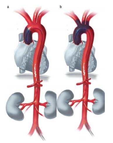 Příloha 13 Harlekýnský syndrom Popis: Harlekýnský syndrom a) krev z ECMO přístroje femorální kanylou zásobuje okysličenou krví tepny aortálního oblouku b) krev z ECMO přístroje femorální