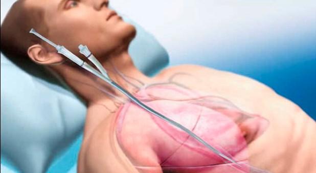 com/assets/documents/product- information/cardiohelp-system/ecls_poster_mcv-pt-20000401-en-