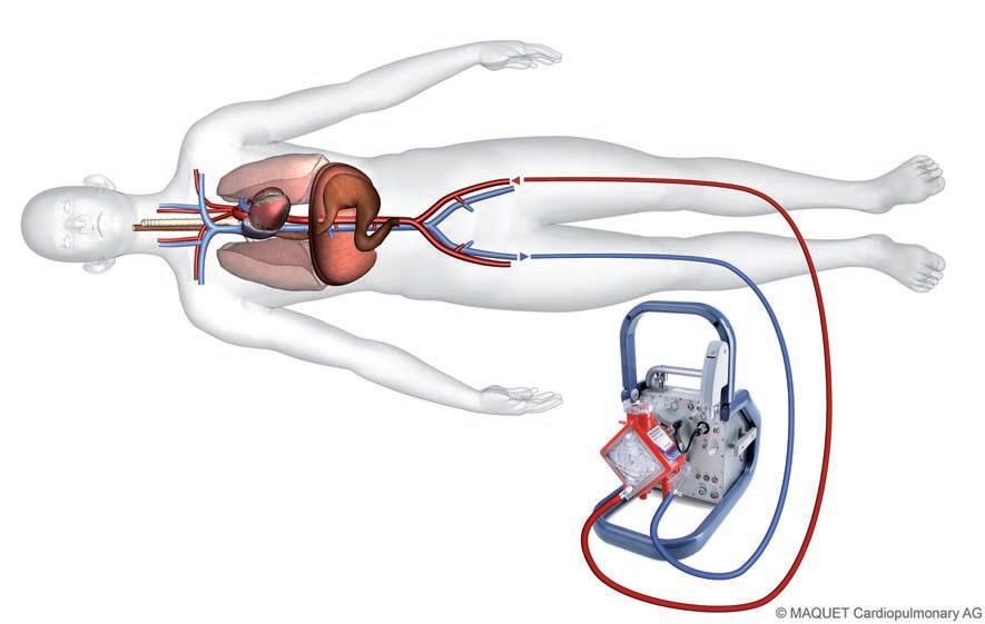 Příloha 4 Schéma V-A ECMO (Retrived from: http://www.maquet.