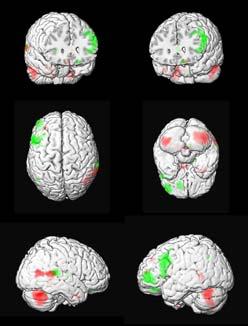 Hipokampus Serotonin Noradrenalin Metodika fmri: Vision T (G=25 mt/m,