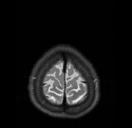 Norma Přední cingulum Schizofrenie Semantické mapy a neuronální sítě