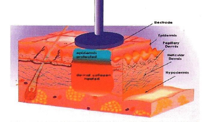 Metodologie Beauty RF, ve snaze dosáhnout nejlepších výsledků, zahrnuje vyvinutí tepla přímo uvnitř tkáně, která je několik milimetrů nad dermis (až do 5 mm) bez pronikání skrz epidermis,