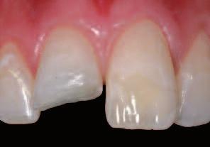 lorenza Vaniniho. Jakýkoliv jiný postup, který nerespektuje anatomii přirozeného zubu, nedokáže využít estetické schopnosti tohoto systému.