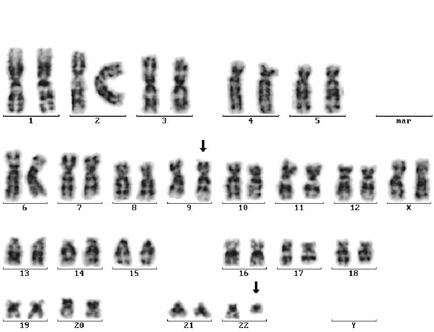 Translokace Přemístění části chromozomu na jiný chromozom