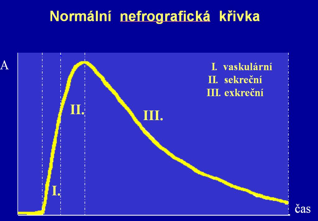 6.Dynamická scintigrafie ledvin Počítač pak vytvoří histogramy, což jsou křivky časového průběhu změn aktivity odpovídající námi vymezené oblasti zájmu.