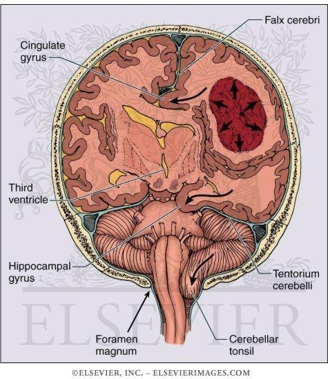 Syndromy IC herniace Subfalcinní Unkální/transtentoriální Centrální Cerebelární/tonzilární