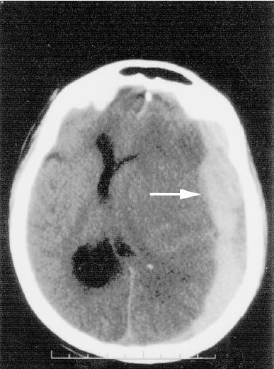 Akutní subdurální hematom Srpkovitá hyperdenzita na CT Vysokoenergetické trauma častější než EDH (cca 30% KCT) přerušení přemosťujících nebo kortikálních cév