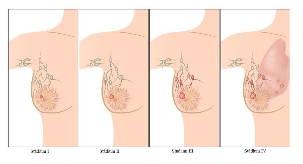3.1.1 Rizikové faktory nízký věk ženy v době, kdy přišla její první menstruace vysoký věk ženy, která má pozdní menopauzu v postmenopauzálním období života ženy se hlavním zdrojem estrogenů stává