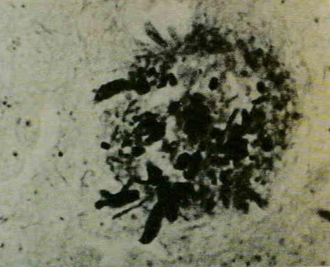 Obrázek 5 - Fotografie neurofibrilárního uzlíku (vlevo) a neuritického plaku (vpravo) pozorované na histopatologickém preparátu z mozku pacienta s AD [12].