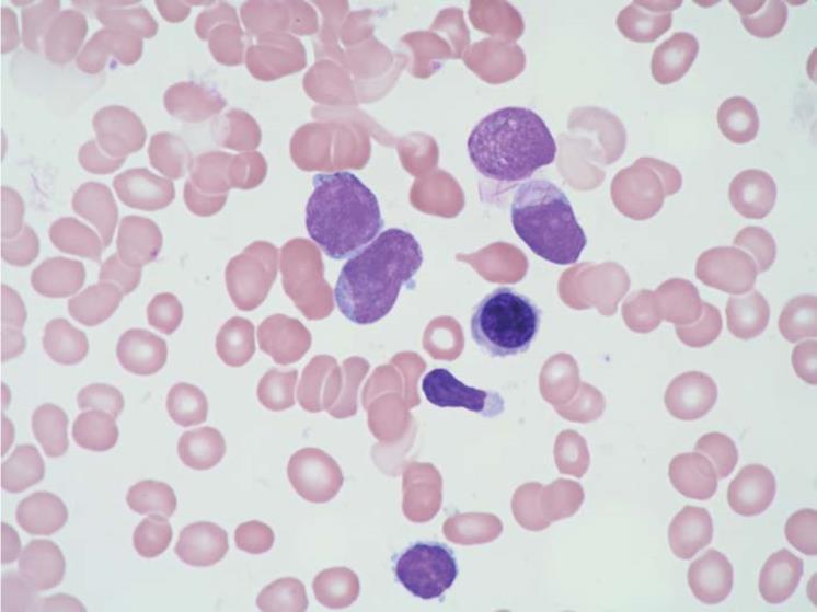 4.4. Leukemie Pojem leukemie popisuje maligní onemocnění hematopoézy, které vzniká na úrovni hematopoetické kmenové buňky.