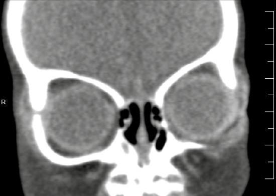 1 Vrozené anomálie hlavy a krku Obr. 1.11 Koronární řez: stenóza apretura piriformis oboustranně Léčba: Chirurgická není většinou nutná, záleží na závažnosti dyspnoe.