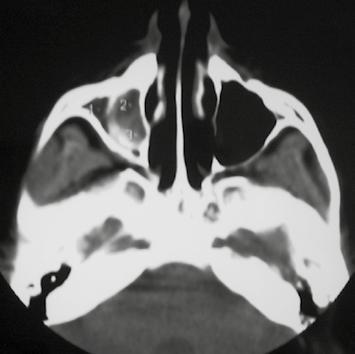 Vrozené anomálie nosu a vedlejších nosních dutin 1 Kongenitální septum v maxilární dutině Kongenitální septum v maxilární dutině, nazývané také primární, vzniká při růstu střední části tváře (30).