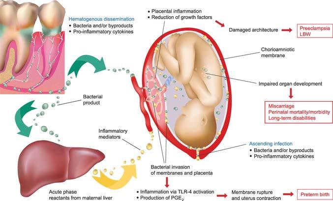 orální mikrobiom Adverse pregnancy outcomes (APOs) ane periodontal disease:pathogenic mechanisms (pages S170-S180)
