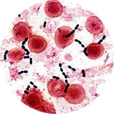 Enterococcus faecalis v hemokultuře http://www.