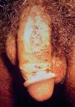 Herpes genitalis http://www.