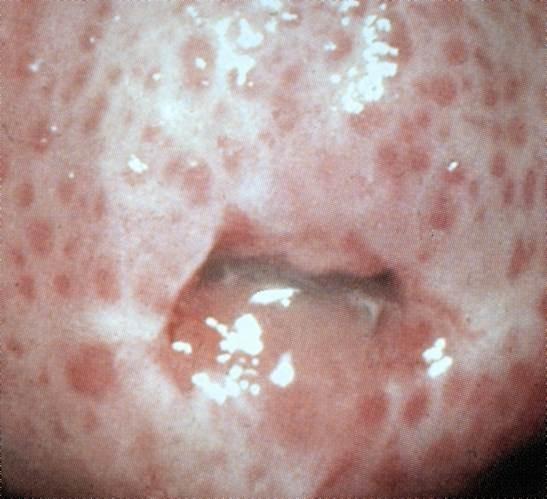 Tzv. jahodový cervix http://webmedia.