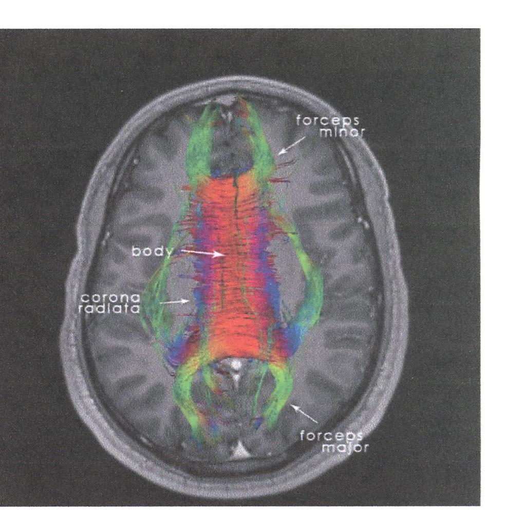 - Corpus callosum