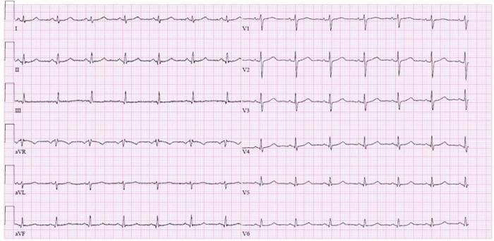 EKG