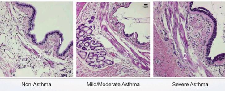 Bronchiální termoplastika AHR typický rys astmatu AHR je