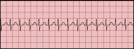 Komorové tachykardie EKG atributy tachyarytmií 0. Frekvence 1.