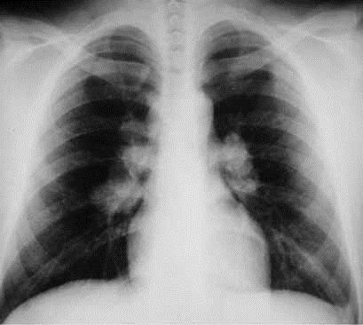Hlavní příznaky Sarkoidóza se klinicky projevuje zpravidla mírně zvýšenou teplotou, hubnutím a zvýšenou únavou. Bývají přítomny i respirační příznaky, a sice dušnost nebo dráždivý neproduktivní kašel.