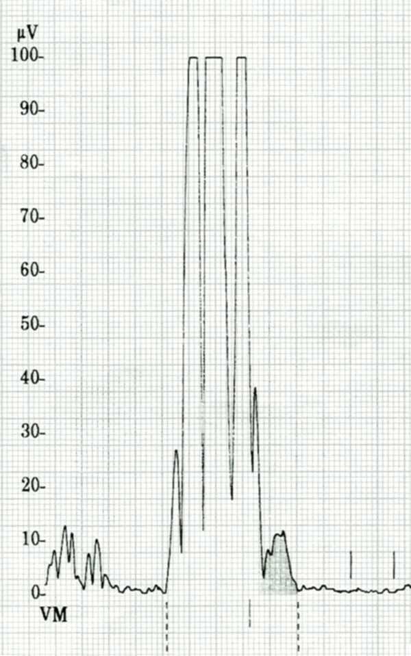 RMS druhá odmocnina RMSSD - odmocnina z průměrů druhých mocnin rozdílů sousedních NN intervalů SAECG zprůměrované EKG SDNN směrodatná odchylka NN intervalů TO nástup turbulence TS strmost poklesu