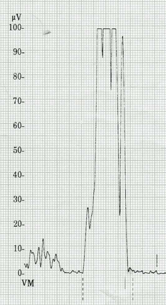 B: Patologický nález zprůměrovaného EKG s přítomností pozdních potenciálů (frms 122, LAS 45ms, RMS 13 uv) A B Obrázek č.