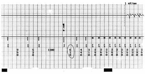 the period of instability (right) Obrázek 2 Záznam z paměti ICD: Polymorfní komorové tachykardie typu torsade de pointes, charakteru proarytmie s účastí