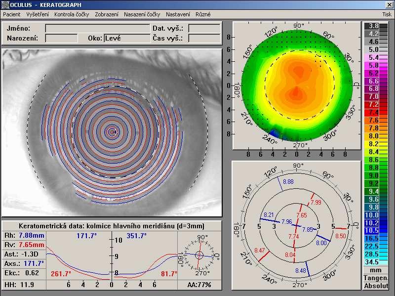 Přehled výsledků vyšetření z keratografu Oculus snímek rohovky s Placidovými kruhy mapa