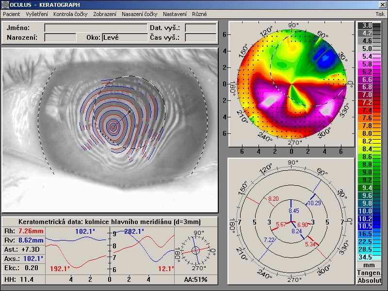 keratoplastika