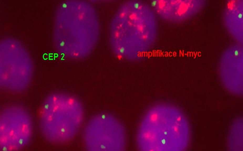 ONKOCYTOGENETIKA příklady typických chromosomových změn - amplifikace genová amplifikace v buňce je přítomno mnoho kopií nějakého segmentu genomu -