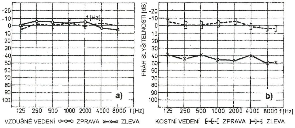 Tónová audiometrie audiogram normálně slyšícího