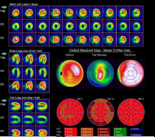 Obrázek 10 Tomografické řezy zobrazující mírně nehomogenní