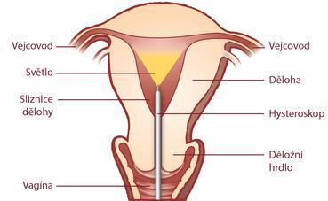 Obrázek č. 10 - Hysteroskopie [39]. Laparoskopické vyšetření je metoda, která umožňuje šetrně prohlédnout dutinu břišní a ověřit průchodnost vejcovodů. Laparoskopie spadá do tzv.