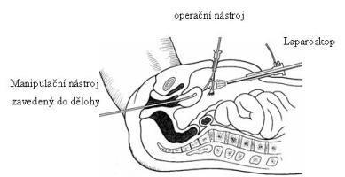 (viz Obrázek č. 11). Pupíkem se zavádí kamera, která snímá operační pole. Poté se provádí další 1-3 drobné řezy (cca 1 cm), kterými se do břicha zavádí potřebné operační nástroje.