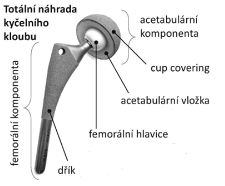 Proto bývá UHMWPE označován jako zlatý standard [20]. Obr. 2-4 Komponenty náhrady kyčelního kloubu [21] 2.2.4 Náhrada kolenního kloubu V současné době se nahrazují pouze poškozené plochy kloubu (povrch kloubu a kloubní chrupavky).